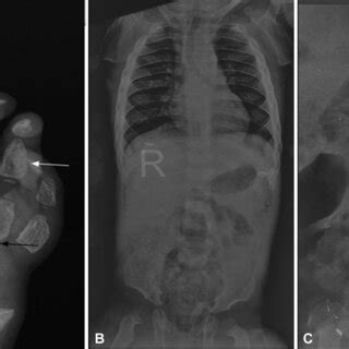 Mucolipidosis Posteroanterior Radiograph Of The Left Hand Showing