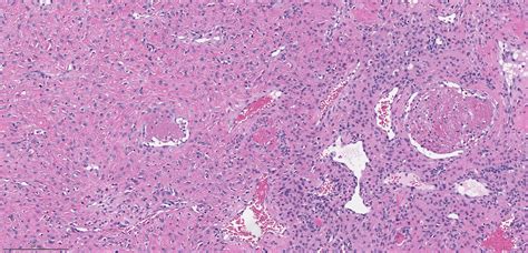 Pathology Outlines Nasopharyngeal Angiofibroma