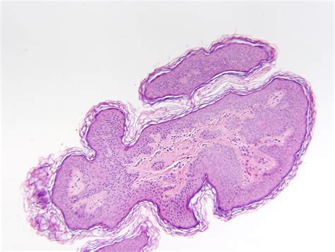 Acrochordon Histology