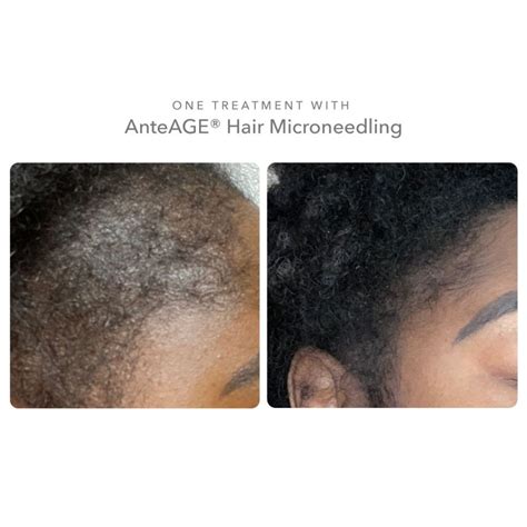 Anteage Md Hair Restoration Treatment Synerchi Medical Spa