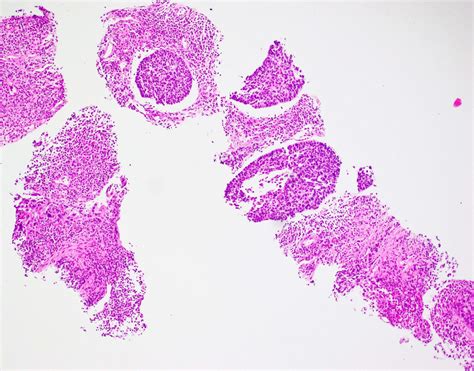 Squamous Cell Carcinoma Basaloid Variant Lung Bosnianpathology