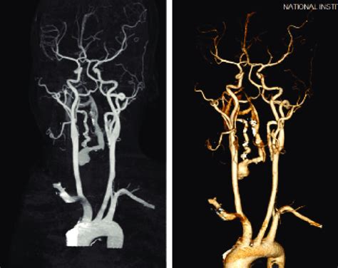 Post Opearative CTA Showing Narrowing Of The InterFistula And