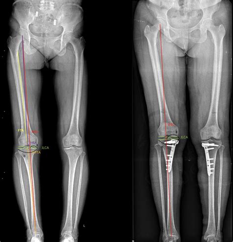 Frontiers Early Surgical Outcomes And Influencing Factors Of High