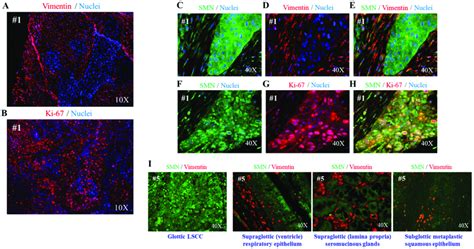 SMN protein is enriched in neoplastic cells of the laryngeal tissue ...