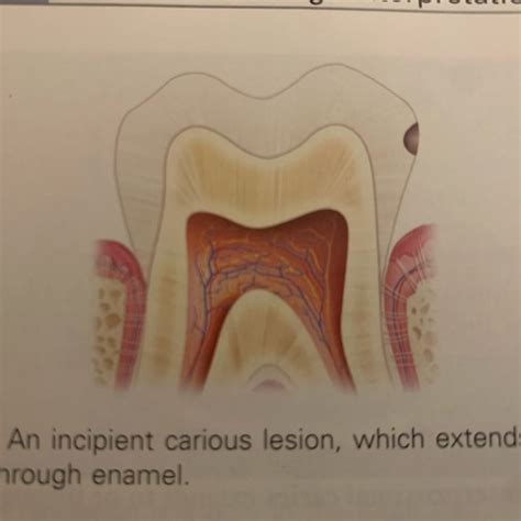 Chapter 33 Interpretation Of Dental Caries Flashcards Quizlet