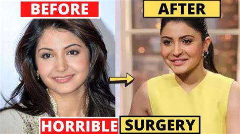 SHOCKING Plastic Surgery Of Bollywood Actresses BEFORE AFTER