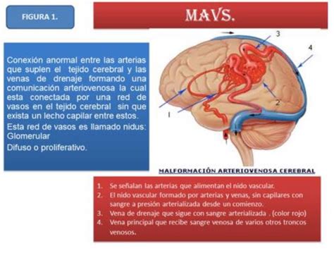 Diagnostico Radiol Gico De Las Malformaciones Arteriovenosas Cerebrales