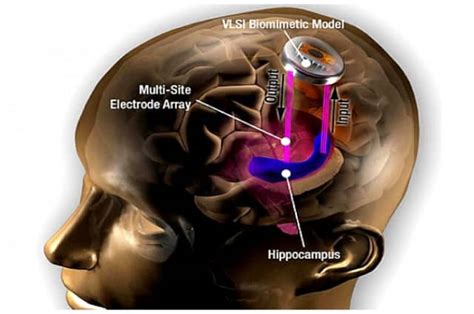 New Brain Implant Technology Can Boost Memory Up To 15 Perce