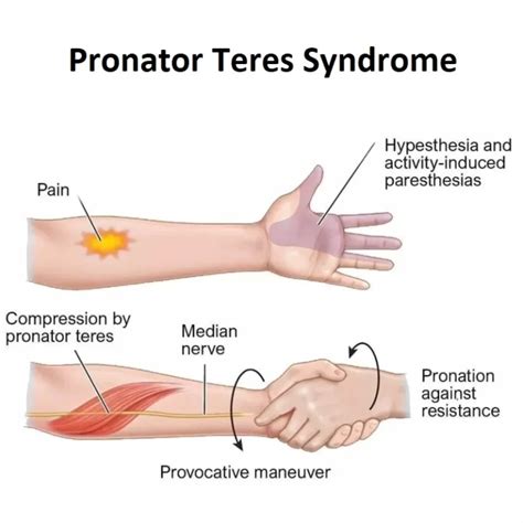 Pronator Teres Syndrome Radiology Archives Mobile Physiotherapy Clinic