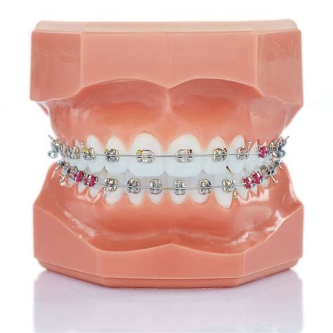 LEGEND Mini Single Wing Mandibular GC Orthodontics Inc