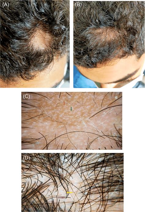 Methotrexate Mtx Case Years Old Male Had A Localized Patch Of