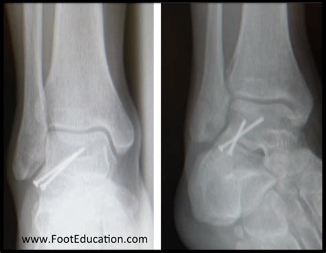 Lateral Talar Process Fractures Footeducation