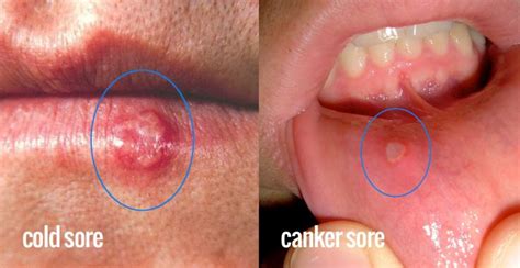 Cold Sores Vs Canker Sores How To Tell The Difference Between The Two