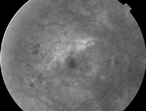 Fluorescein Angiography Taken One Month After The Second Bevacizumab Download Scientific