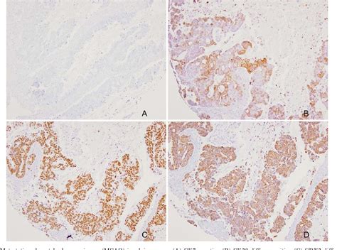 Table From Ck Ck Cdx And Muc Immunohistochemical Staining Used