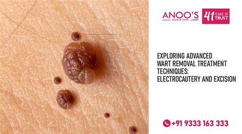 Exploring Advanced Wart Removal Treatment Techniques