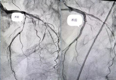 重醫大附二院秀山分院在渝東南片區率先開展血管內超聲指導下冠脈旋磨術 每日頭條
