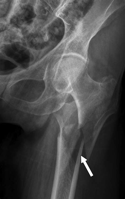 Femoral Neck Fracture X Ray