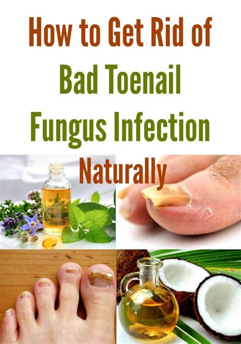 How To Get Rid Of Bad Toenail Fungus Infection Naturally In 2020 Nail