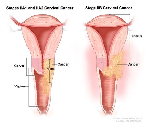 Cervical Cancer Stages Nci