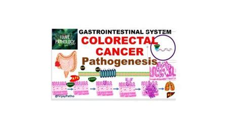 Pathogenesis Of Colorectal Cancer Pathology Made Simple