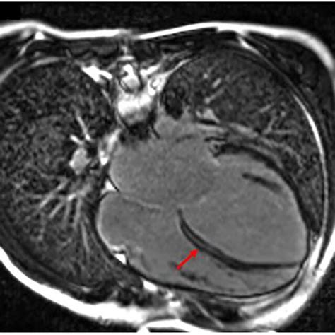 Patient 1 Focal Image Of The Cardiac Magnetic Resonance Imaging MRI