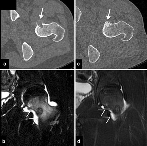 Osteoblastoma Of The Femoral Neck Ct A And Mri T2 Fat Sat B