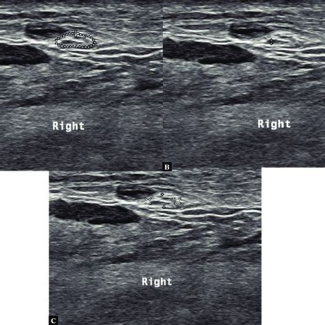 Glasgow Ultrasound Enthesitis Scoring System. | Download Table