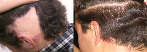 Special Case Hair Transplant Photos — Ziering Medical