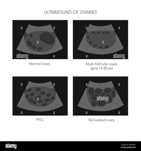 Medical Vector Illustration Of Ovaries Ultrasound With Normal