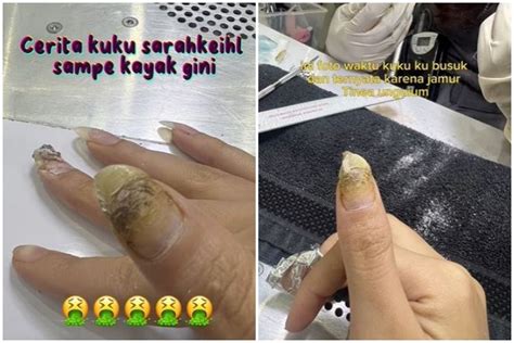 Kuku Selebgram Ini Jadi Busuk Usai Lakukan Nail Art Berubah Menghitam