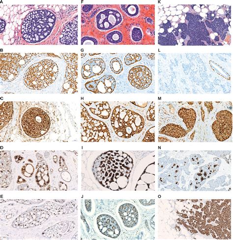 Morphological And Immunohistochemical Features Of Adenoid Cystic