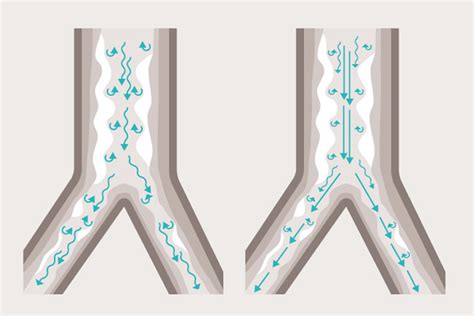 Heliox Helping Patients Breathe Easier