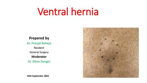 Ventral hernia | PPT