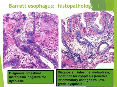 Pathology Of The Esophagus