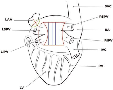 Jcm Free Full Text Robotic Assisted Epicardial Hybrid Ablation And