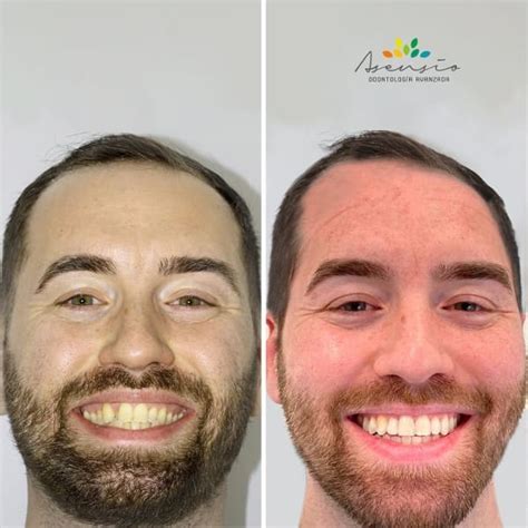 Caso Clinico Antes Y Despues De Tratamiento De Ortodoncia Invisalign