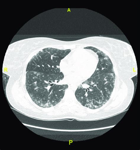 High Resolution Computed Tomography Hrct At First Presentation It