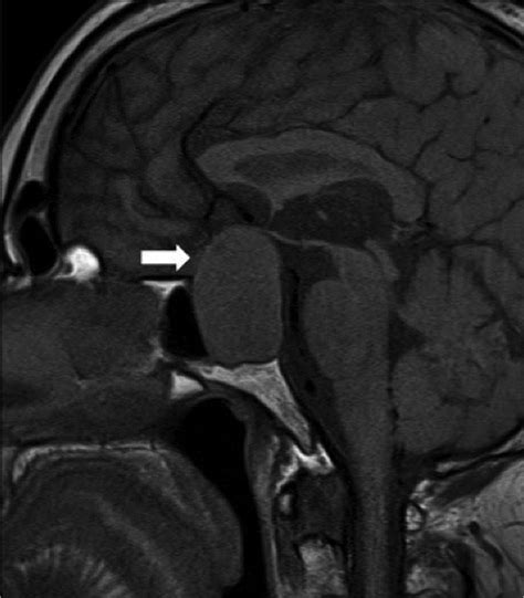 Giant Pituitary Adenoma Bmj Case Reports