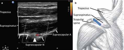 Suprascapular Nerve Block | Anesthesia Key