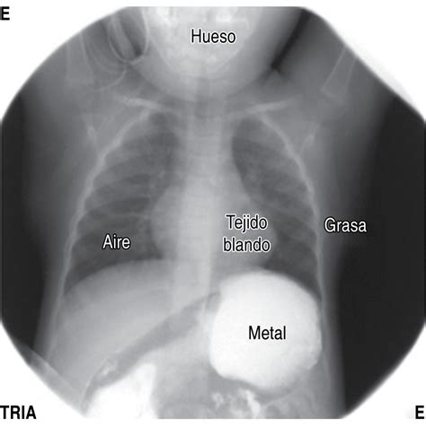 Radiografía De Tórax En Pediatría Una Interpretación Sistematizada