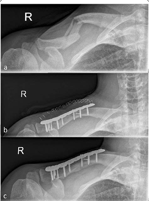 X Ray Images Of A Fragmentary OTA 2 C Midshaft Clavicle Fracture