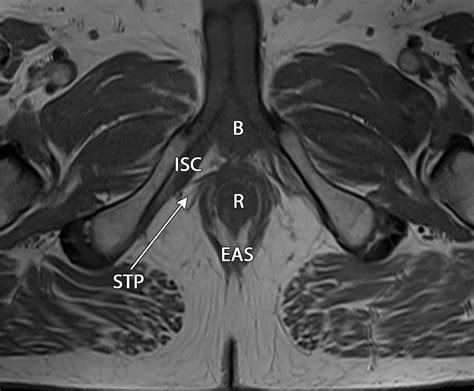 MRI Of The Male Pelvic Floor RadioGraphics