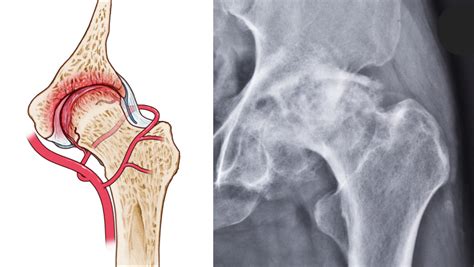 Proximal femoral fracture