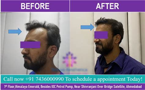 Hair Transplant In Ahmedabad Gujarat Rejuva Aesthetica