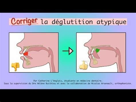 Pingl Sur D Glutition Atypique