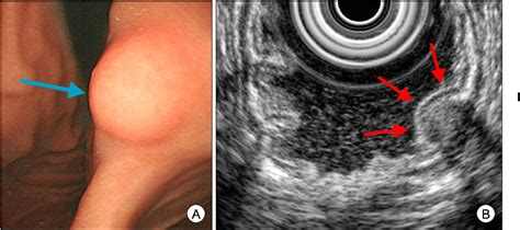 Figure 1 From Calcifying Fibrous Pseudotumor Of The Stomach That Was