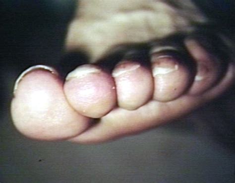 Onycholysis - wikidoc