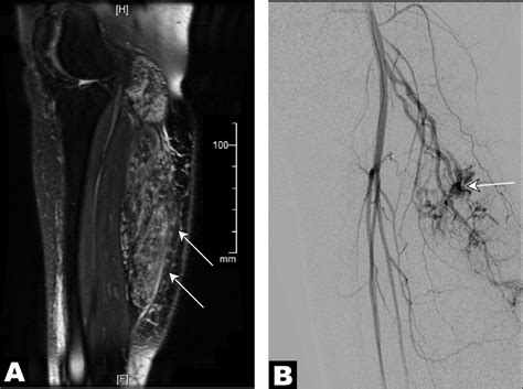 Contrast Enhanced Sonography As A Novel Tool For Assessment Of Vascular