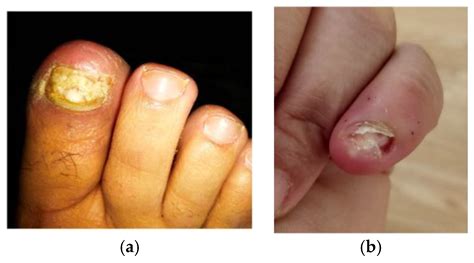 Staph Infection Fingernail